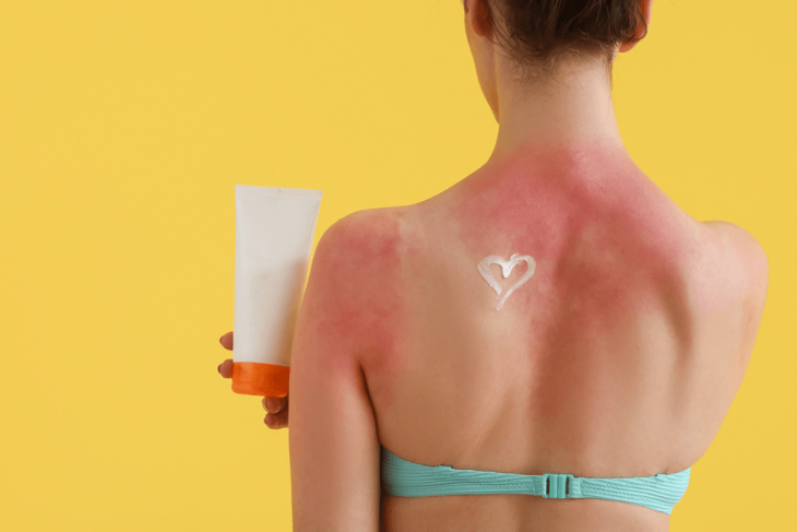 Sluneční alergie: Jak se projevuje a jak s ní bojovat?